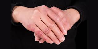 Image result for Chilblains