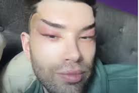 Żywy Ken' pokazał się po operacji powiek i usunięciu wypełniaczy. 'Wygląda  o wiele lepiej'