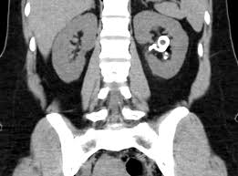 Image result for Nephrolithiasis Imaging
