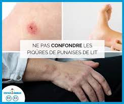 Dans les tissus, les meubles, les rideaux, les appareils électroniques et surtout le matelas, elles s'immiscent partout et persistent. Punaises De Lit Symptomes Docteur Nuisibles