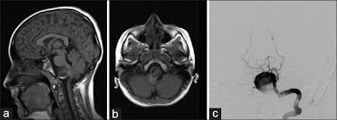 Learn vocabulary, terms and more with flashcards, games and other angiografia por rm detecta aneurismas 3mm angiografia por tac los detecta hasta >7mm. Aneurisma Gigante De Arteria Vertebral En Paciente De Edad Pediatrica Surgical Neurology International