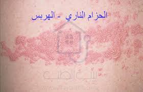 Maybe you would like to learn more about one of these? Ø¨ÙŠØª Ø§Ù„Ø·Ø¨ Ù‡Ù„ Ø§Ù„Ø­Ø²Ø§Ù… Ø§Ù„Ù†Ø§Ø±Ù‰ ÙŠØ³Ø¨Ø¨ Ø§Ù„ÙˆÙØ§Ø© Ø£Ùˆ Ù…Ø¹Ø¯ÙŠ Ø§Ø¹Ø±Ø§Ø¶Ù‡ ÙˆØ¹Ù„Ø§Ø¬Ù‡