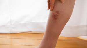 Image result for erythema nodosum