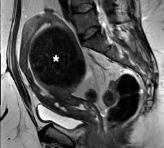 Image result for Leiomyosarcoma