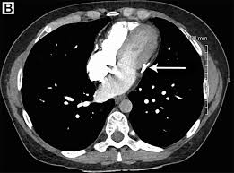 Pericarditis is caused by inflammation of the sac that holds the heart and is found in around 5 percent of all patients admitted to the emergency department for chest pain unrelated to a heart attack. Constrictive Pericarditis