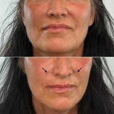 Danielle Leeds, RN (@aestheticnurse.danielle) • Instagram photos and videos