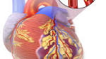  New marker could help to identify heart attack patients most at risk
