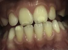 And therefore some of this enamel can be sacrificed (shaved away) without resulting in tooth harm. The Difference In Symmetry Of The Enamel Defects In Celiac Disease Versus Non Celiac Pediatric Population Sciencedirect