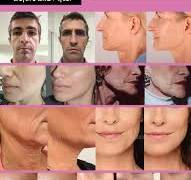 Calcium Hydroxylapatite skin booster Non-crosslinked ...
