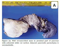 Xanthogranulomatous Pancreatitis Mimicking Solid Pancreatic Tumor
