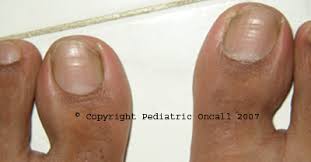 Image result for Beau lines feet