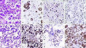 Although most studies described that canine mesotheliomas have been seen with both pleural and pericardial effusion 2, 4, 5, 7, 8, in our case we did not determine any evidence of pericardial effusion and even effusion in abdominal cavity. Pleural Fluid All Cell Blocks A D Pleural Mesothelioma Epithelial Download Scientific Diagram