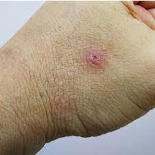 We did not find results for: Acne Papules Causes Treatments And Prevention Tips