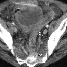 Image result for Radiation Colitis