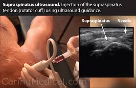 Partial Rotator Cuff Tear Do You Really Need A Surgery Caring Medical Florida