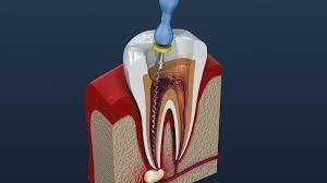 How Long Does A Root Canal Take In 2020 Smile Angels Of Beverly Hills