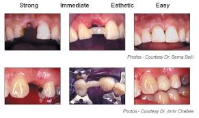 Check spelling or type a new query. Ribbond Single Visit Bridge Dentistinbali