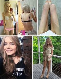 Anorexia before and after pictures. These Before And After Images Of People Who Overcame Anorexia Are Nothing Short Of Inspirational