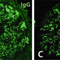 Poststreptococcal glomerulonephritis (psgn) is characterized by rapid deterioration of kidney immunofluorescence (if) combines the use of antibodies with fluorescence imaging techniques to. Poststreptococcal Glomerulonephritis A Light Microscopy Global Download Scientific Diagram