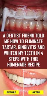 How do you use a dental scaler to remove tartar? 10 Tartar Removal Ideas Teeth Health Healthy Teeth Teeth Care