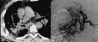 Image result for Broncholithiasis