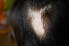 These patches may connect, however, and then become noticeable. Hair Loss And Thinning Hair In Women