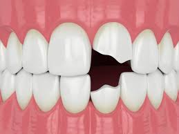 3 ways a cosmetic dentist could give you vampire teeth. Can I Contour My Canine Teeth Everything You Need To Know