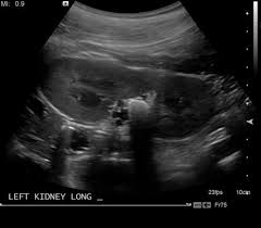 Cystinuria Radiology Reference Article Radiopaedia Org