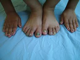 Image result for Yellow nail syndrome feet