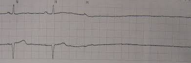 An automated external defibrillator (aed) is a piece of equipment that serves a critical function in many types of medical settings. Asystole Wikipedia