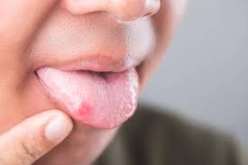 Image result for mouth ulcer on tongue)