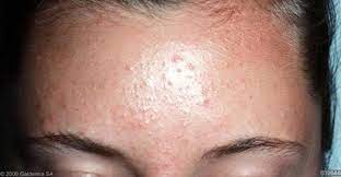 It's important to note that if you have naturally oily skin you're more likely to experience fungal. Are Those Bumps On Your Skin Fungal Acne By Nudie Glow Medium