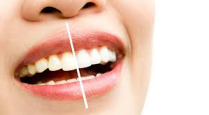 5 Bahan Untuk Memutihkan Gigi Yang Simple Audy Dental