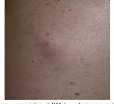 Incidence of merkel cell carcinoma in renal transplant recipients. Figure 1 From Merkel Cell Carcinoma Semantic Scholar