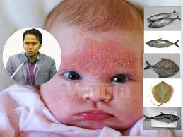 Tenggorokan gatal bisa menjadi gejala dari reaksi alergi yang muncul saat anda terpapar zat kondisi tubuh yang kekurangan cairan bisa menyebabkan tenggorokan menjadi kering dan gatal. 5 Jenis Ikan Patut Dielakkan Bagi Penderita Ekzema Gerd Wanita Berpantang Penyebab Gatal Angin Mingguan Wanita