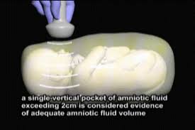 Image result for Biophysical Profile