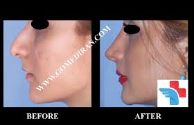 How much does it cost to get a nose job. What Is Rhinoplasty Blog Gomediran