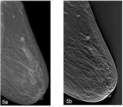 The distortion arises from the scarring process . A Dm Mlo View Of The Left Breast Shows A Dense Area Of Architectural Download Scientific Diagram