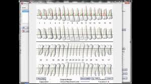 perio chart video by ez 2000 plus dental software