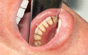 When plaque collects on teeth it hardens into tartar, also called dental calculus, on your teeth which can lead to serious gum disease. If You Have Tartar Or Calculus You May Be At Risk Of Calcified Arteries And Heart Disease Tc Dental Group