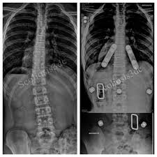 Frontal Plane Correction Sagittal Plane Correction Scoliosis Is A Dysfunction Of The Spine That Occurs In 3 Planes So The Correction Of The Spine Needs To I 2020