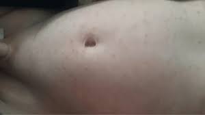 Image result for scabies norvegica