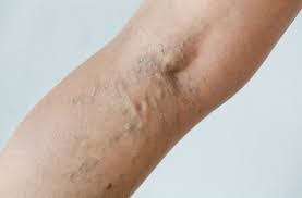 Bananas are crammed with vitamins, antioxidants, and minerals that contain amazing benefits for hair and skin. How To Get Rid Of Breast Veins Short Hills Dermatology