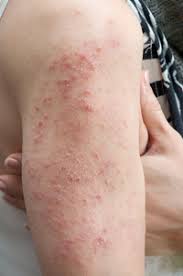 Many parents wonder how can you tell hives vs rash. I M Not Sure Why I Keep Getting Hives University Of Utah Health