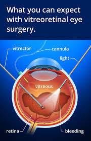 Vitrectomy And Vitreoretinal Eye Surgery In 2020 Eye Surgery Eye Health Ophthalmic Surgery
