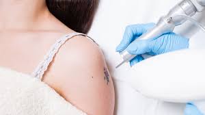 Laser tattoo removal is regarded as the most effective method of getting rid of tattoo regrets. After Tattoo Removal The Ink Is Excreted Through Body Waste Allure