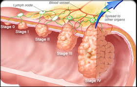 Check spelling or type a new query. Cancer Of Bone Marrow Cancerwalls