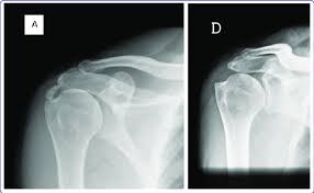 Image result for Rotator Cuff Calcification