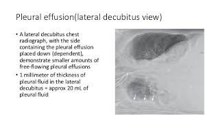 Pleural fluid studies were suggestive of a transudative process, though with some abnormal characteristics (including lymphocyte predominance, as well as presence of signet cells). Pleural Effusion X Ray Findings