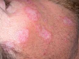 Learn more about the symptoms, complication, causes, types, diagnosis, treatment, lifestyle changes, and outlook for lupus. Diskoider Lupus Erythematodes Deximed